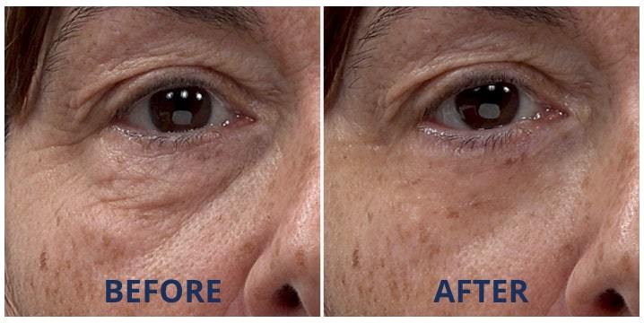 Neila’s under-eye bags and wrinkles visibly disappeared in less than 10 minutes.