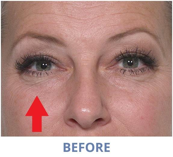 Tiffany before applying Rapid Reduction Serum