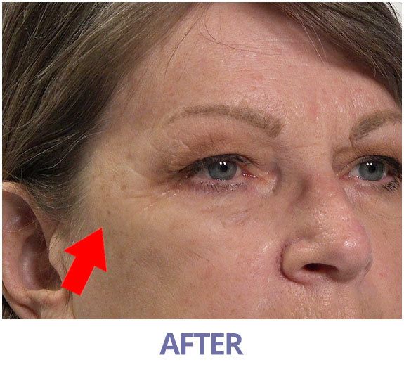 Mona After Plexaderm